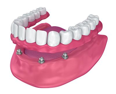 Diagram of implant dentures in Elk Grove