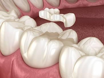 Diagram of dental inlay in Elk Grove CA