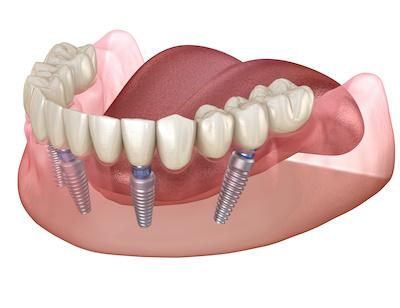 Diagram of dental implants in Elk Grove