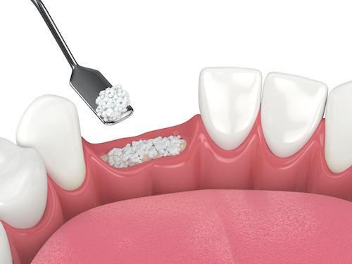 Diagram of ridge augmentation in Elk Grove