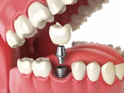 Diagram of a dental implant in Elk Grove