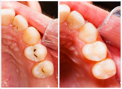 Before and after composite fillings in Elk Grove, CA