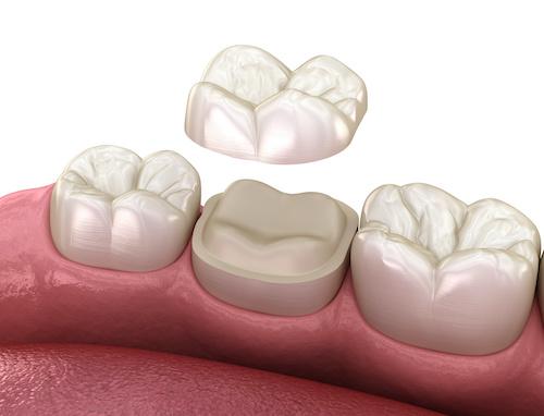 Diagram of a dental onlay in Elk Grove CA