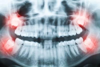 X-rays showing the need for a tooth extraction Elk Grove 