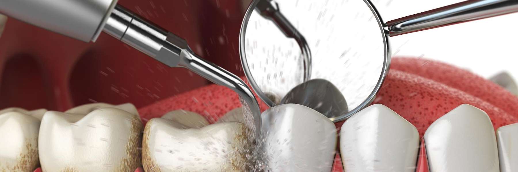 A diagram of a dental cleaning