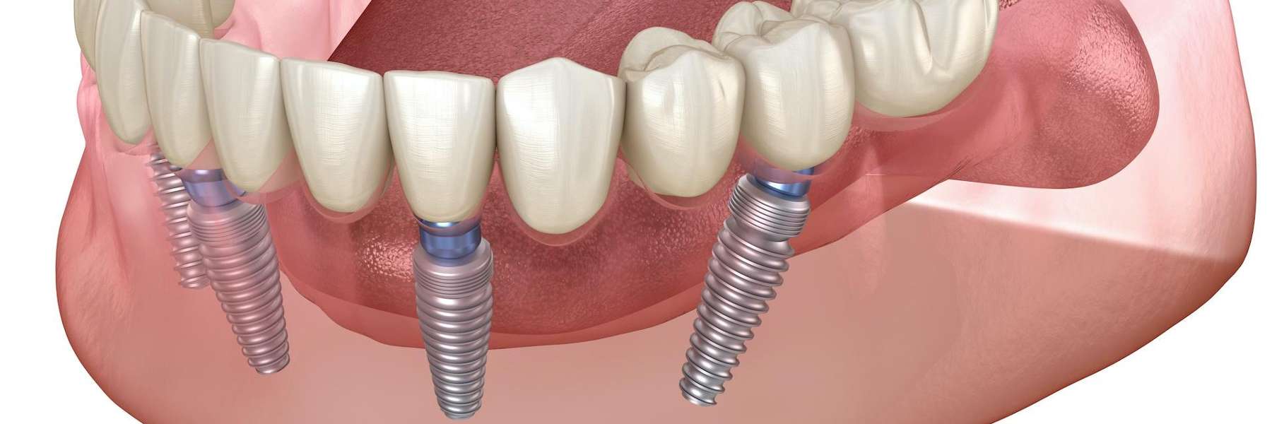 Diagram of dental implants in Elk Grove