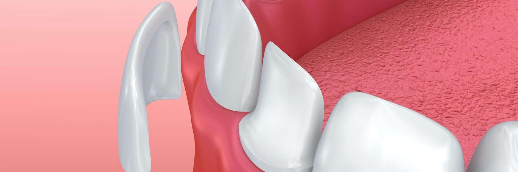An illustration of veneers | Elk Grove dentists
