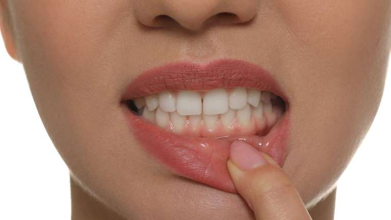 A woman showing her teeth | dentist in Elk Grove