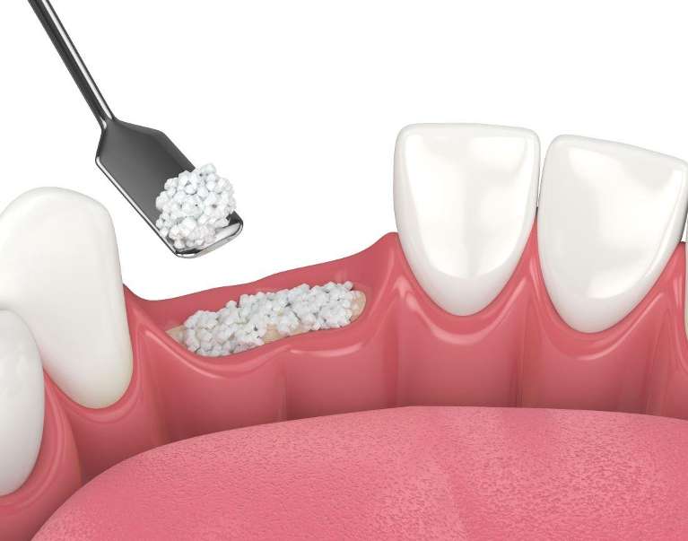 An illustration of bone grafting in Elk Grove