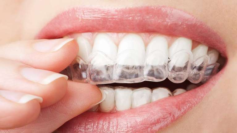 A woman putting in her Invisalign Clear Aligners