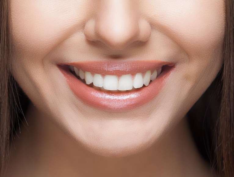 A close-up of a smiling woman's teeth