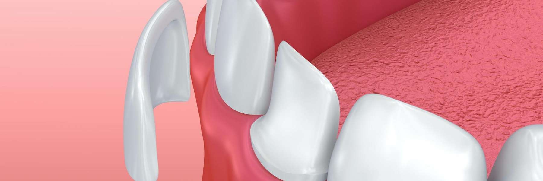 Illustration of a dental onlay
