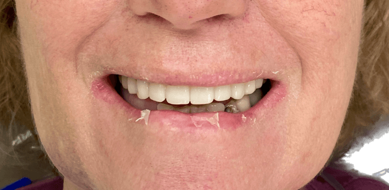 Patient after all on one dental implants in Elk Grove