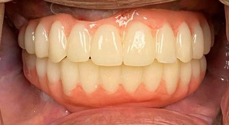 Patient's All-on-6 Same-Day Results