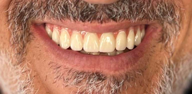 All-on-X-Implants-Upper-After-Image