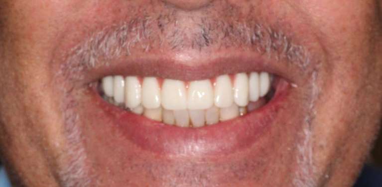 Patient teeth after getting all on x dental implants