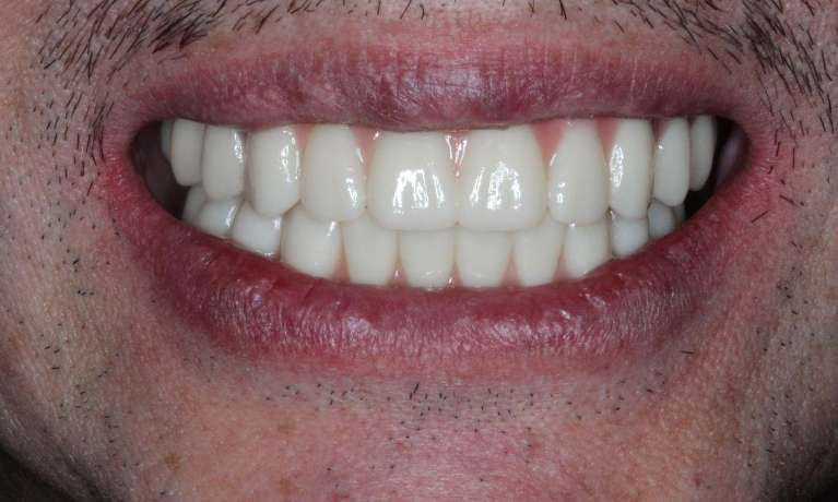 Patient teeth after all - on - x dental implants