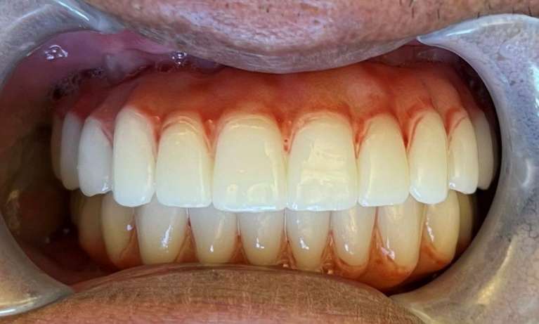 Patient teeth after receiving all on x dental implants