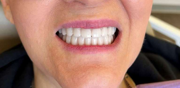 A woman after all on x dental implants in Elk Grove