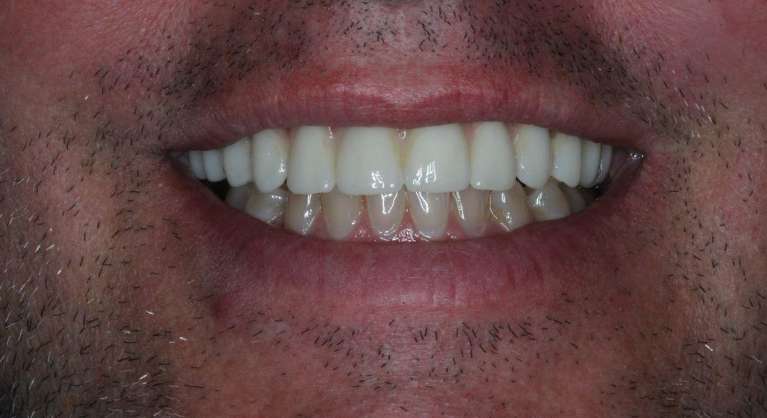 Laguna Springs patient after Implant Bridge