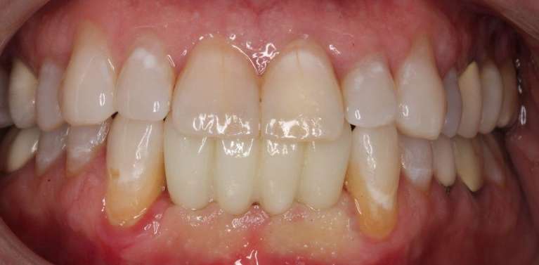 Implant-Bridge-After-Image