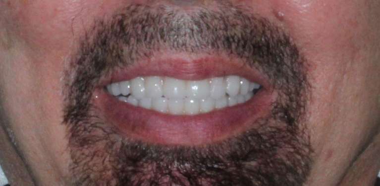 Patient after two to one dental implants