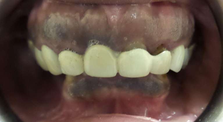 Patient missing multiple teeth