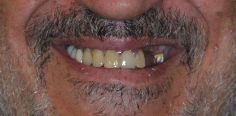 All-on-X-Implants-Upper-Before-Image