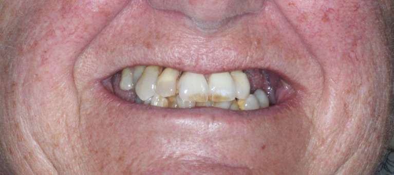 All-on-X-Implants-Before-Image