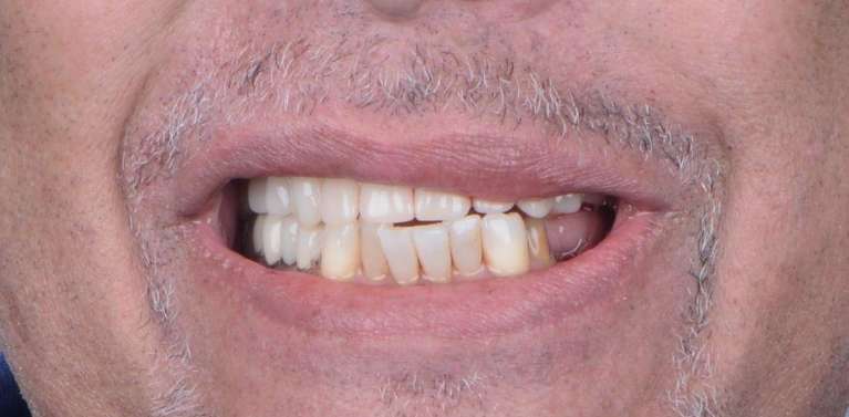 Patient missing teeth before all on x dental implants