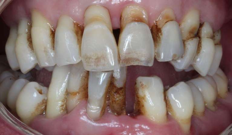 Patient with damaged and missing teeth before dental implants
