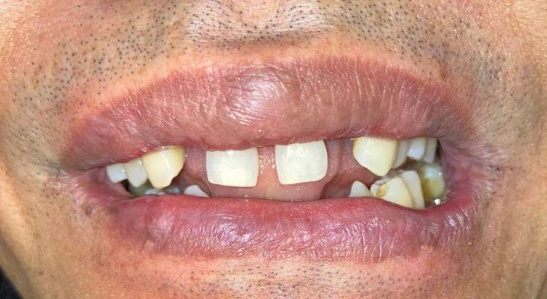 A patient with missing teeth before dental implants