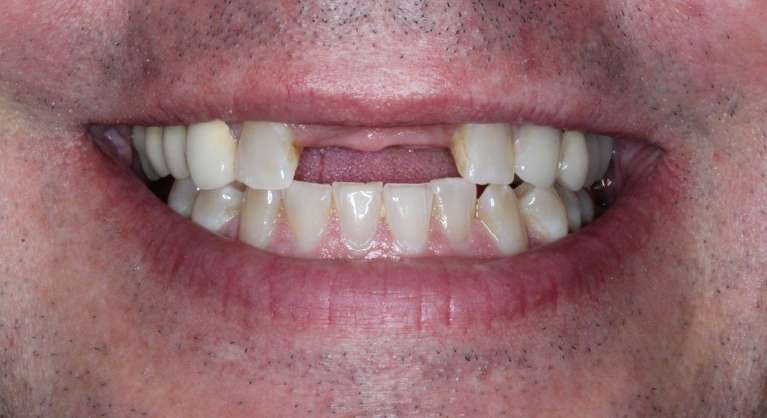 Laguna Springs patient before Implant Bridge