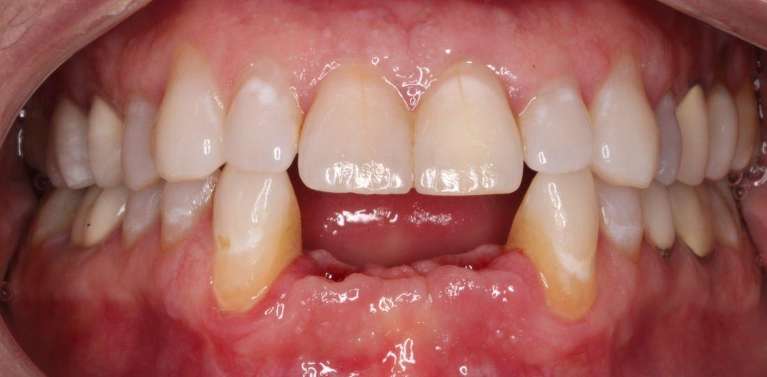 Implant-Bridge-Before-Image