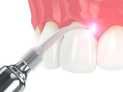 Laser Dentistry in Elk Grove